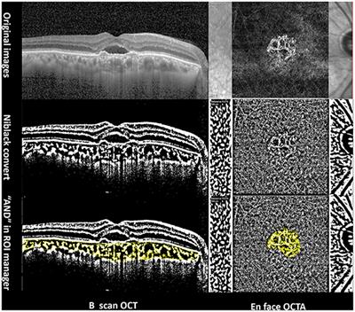 Imaging Characteristics of Neovascular and Atrophic Pachychoroidal Spectrum Diseases